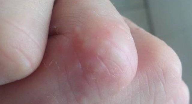 手上长透明小水泡,是上火吗?或许很多人想错了,原来是它在作怪