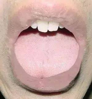 红绛舌常见于图片