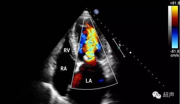 二尖瓣狭窄超声特点