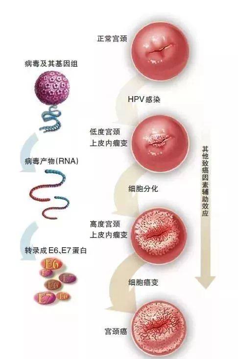 内生型宫颈癌图片图片