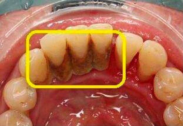 知道吗在不知不觉中牙结石已经开始腐蚀你的牙齿了