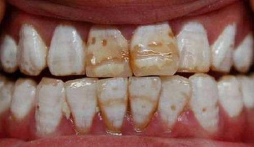 1,四环素牙颜色的种类:颜色柠檬黄为土霉素,颜色镉黄为金霉素.