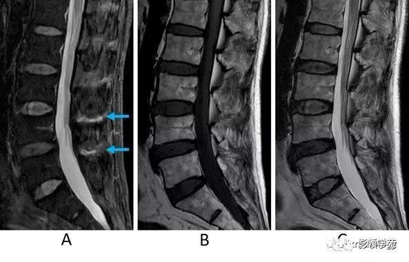 提示棘间韧带退变或损伤
