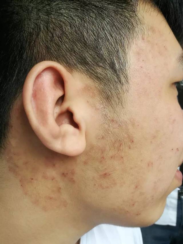 常见面部皮肤病科普:面癣