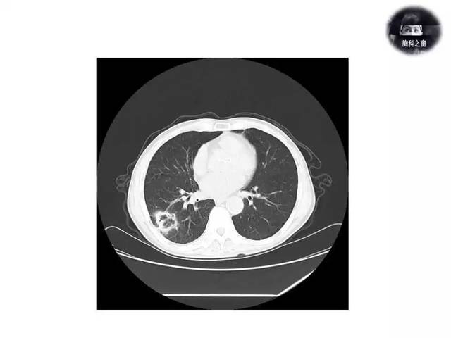 低分化肺鳞癌图片