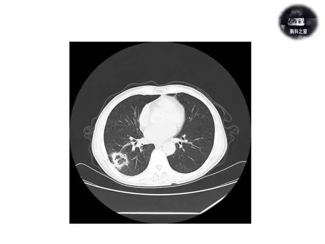 肺鳞癌ct图片