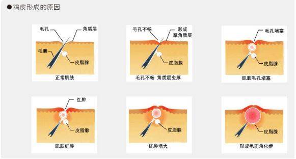 鸡皮肤是什么意思网络用词的简单介绍 鸡皮肤是什么意思网络用词的简单介绍