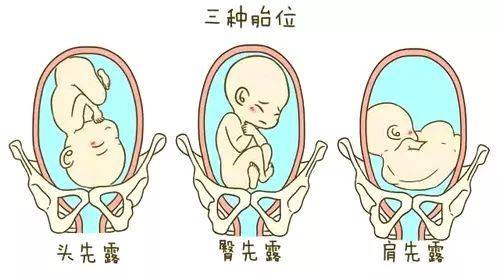 胎心位置图图片