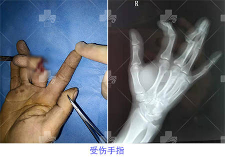 僵指/手指弯曲功能受限，人工指间关节置换术变形记！_手机搜狐网