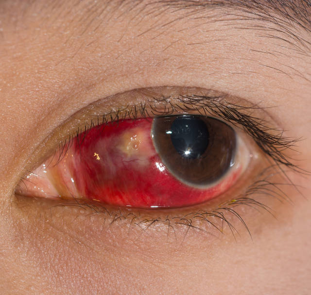 表现为眼睛充血肿胀,有瘙痒和疼痛感,眼部出现少量粘稠物,如果闭眼