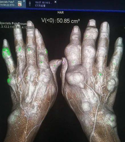 手部x线侧位片双手实图影像图片患者男,72岁,于10年前因痛风性关节炎