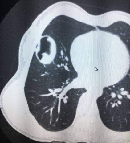 肺包虫囊肿病囊肿图片图片