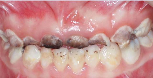 铅中毒牙龈图片