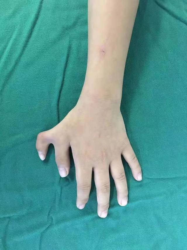 【关注】11岁女孩为何有11根手指?_手机搜狐网