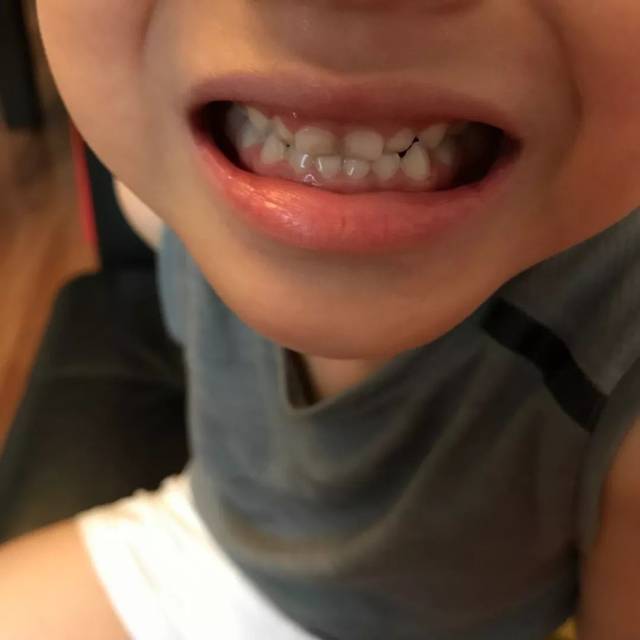 孩子牙齿不整齐,地包天,几岁矫正最合适?