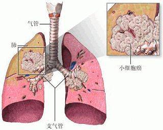 腫瘤醫案丨與小細胞肺癌患者的對話