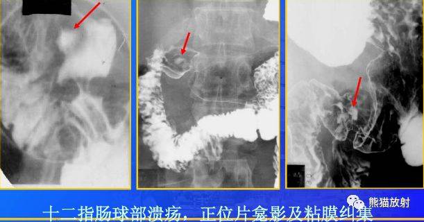 x線診斷要點丨十二指腸球部潰瘍,憩室,十二指腸淤滯症