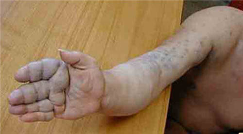 专家支招:如何鉴别婴幼儿血管畸形与血管瘤