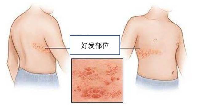疱疹传染不 搜狐网