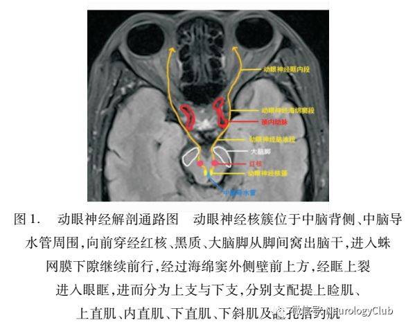 专家述评动眼神经麻痹的诊断及处理原则