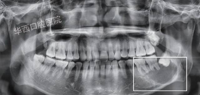 牙根吸收x光片图片