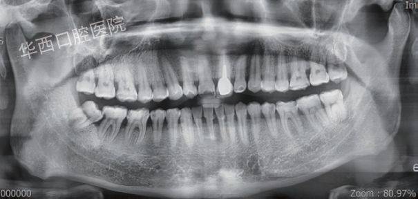口腔断层解剖图ct图片