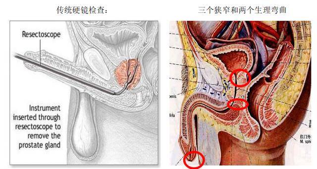由于男性患者生理解剖有三个狭窄和两个生理弯曲,行膀胱硬镜检查时