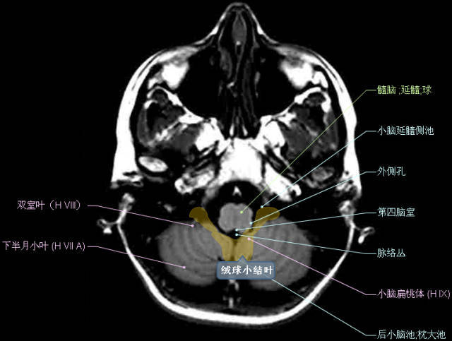 听神经解剖图核磁共振图片