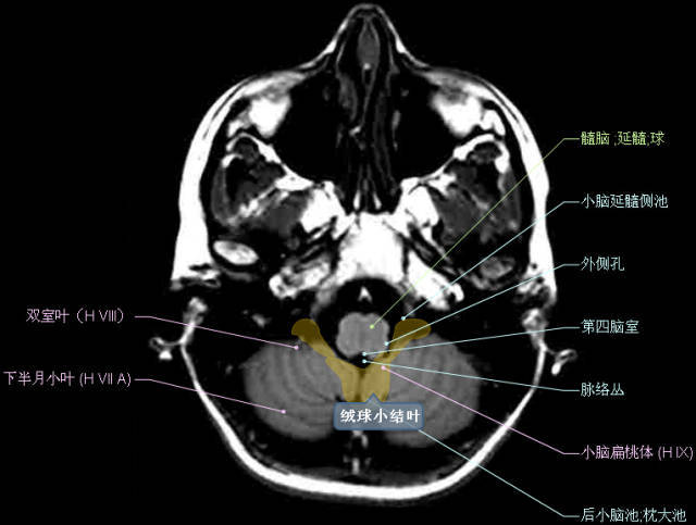 神經解剖| 頭顱mr軸位解剖圖