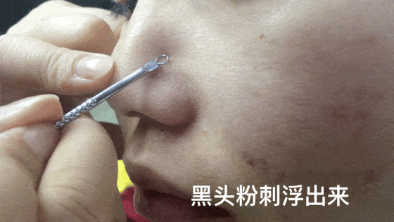 浮出来的黑头油脂,用粉刺针轻轻刮掉即可.