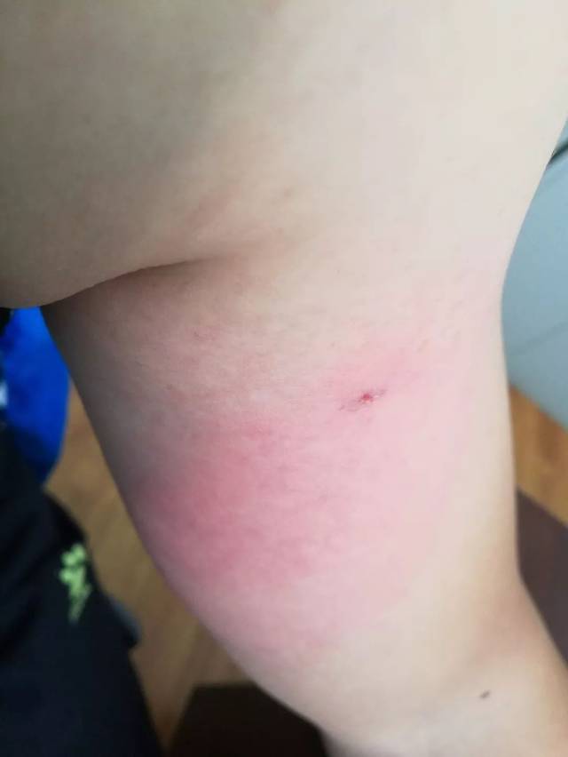 马蜂蛰了怎么处理 被蜜蜂蛰到了应怎样处理_中蜂网