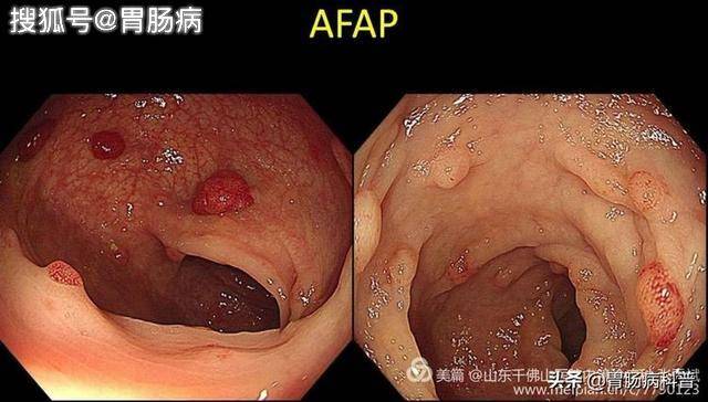 直肠管状腺瘤是什么图片