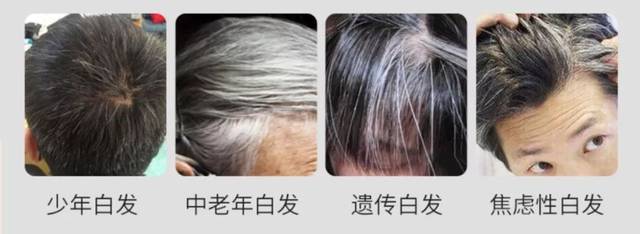 同事亲测,新生黑发,瑞士专利28天告别白发!