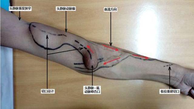 自体内瘘血管穿刺方向选择对血液透析充分性的影响