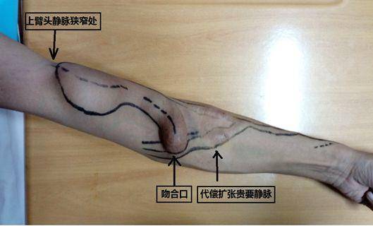 透析瘘管手术步骤图解图片