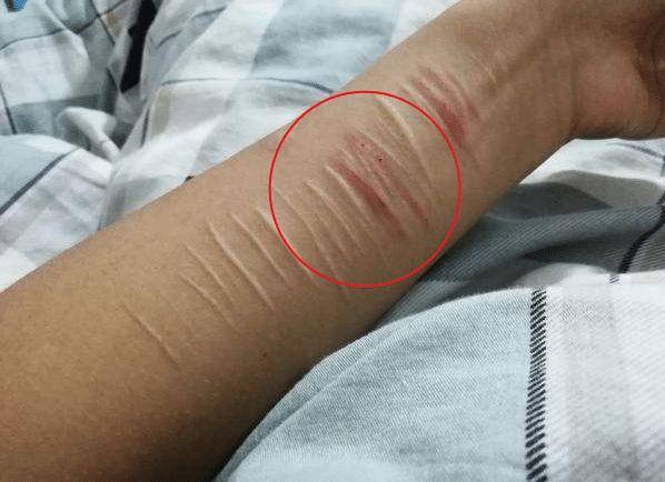 第一种情况,有自残的行为.