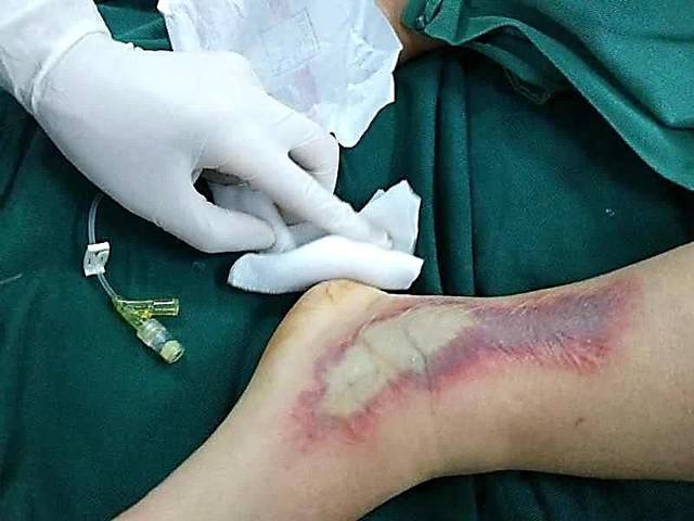 药物外渗致组织坏死中医疗法了解一下