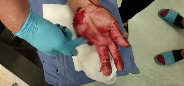 骨科专家施妙手 断指再植技艺高