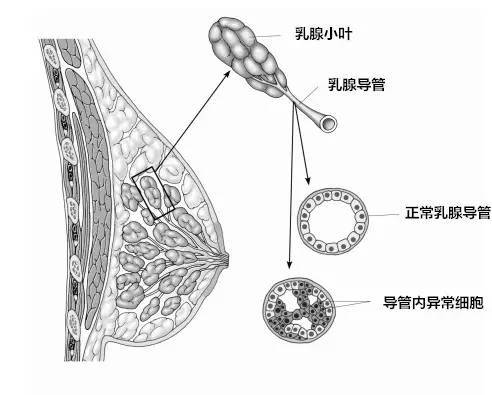 导管原位癌(dcis,也被称为导管内癌)是非浸润性乳腺癌,是一种癌前病变