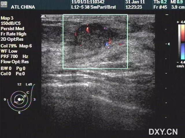 乳腺超声低回声图片