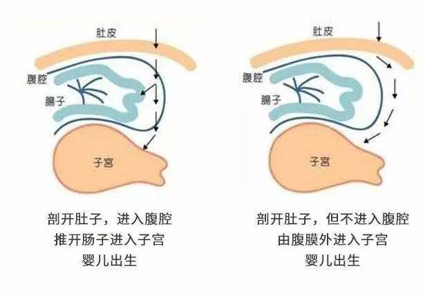 什么是腹膜外剖宫产术