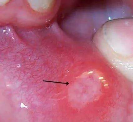 口腔溃疡假膜图片