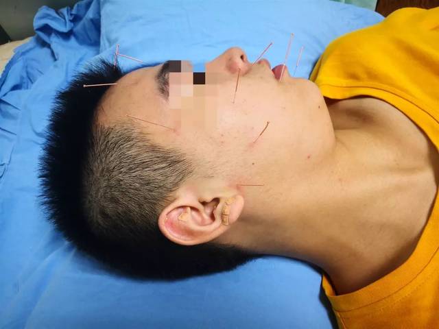 熬夜上网通宵吹空调,面瘫了!针灸加穴位按摩,好了!
