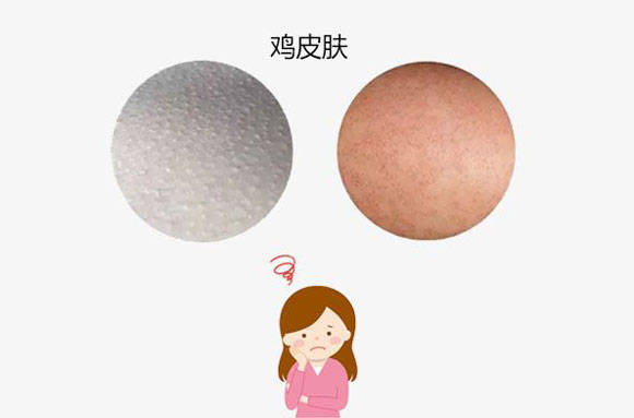 鸡皮肤是会传染吗(鸡皮肤是会传染吗图片)