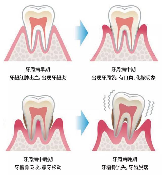 日本百年品牌专攻牙龈出血牙周病的极盐牙膏舒缓口腔清新口气