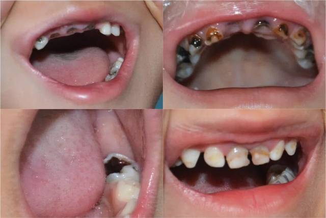 宝宝一口小黑牙怎么办?给宝宝涂氟,真的有必要吗?