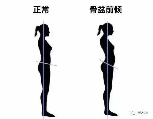 为什么会骨盆前倾图片