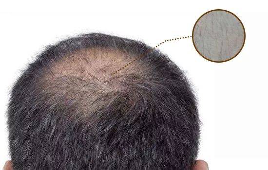 头发变细软有的像"汗毛",有什么办法可以生发?