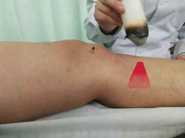 热敏灸有多好您来了就知道