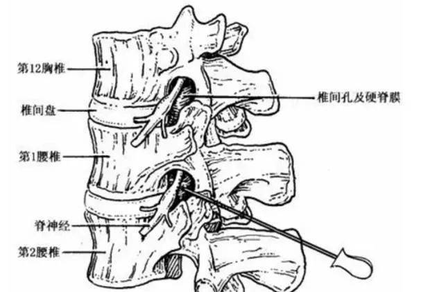 了解腰椎管狭窄,只用1分钟